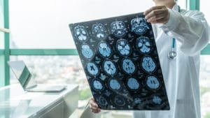 How Our Houston Personal Injury Lawyers Can Help You With a Brain Injury Claim