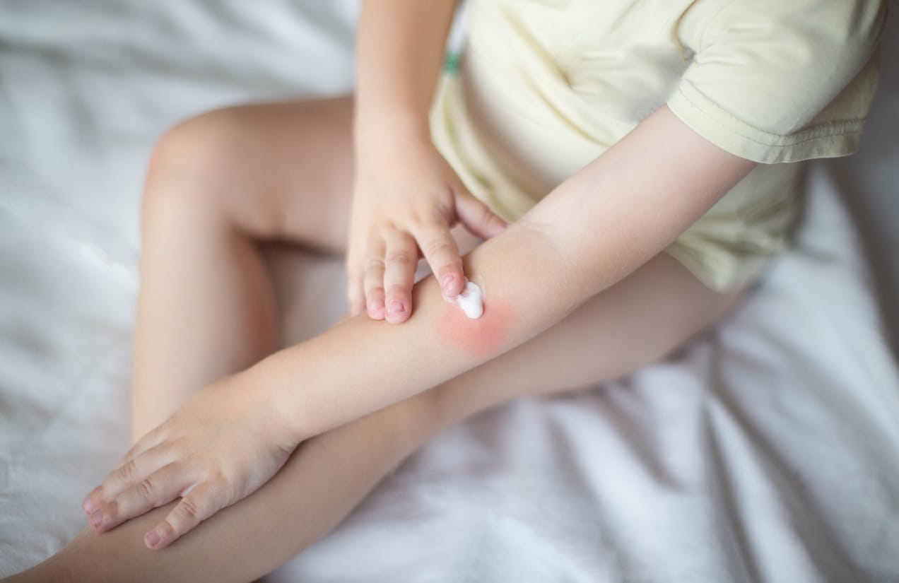 Everything You Need To Know About Hot Water Scalding Burns on Children