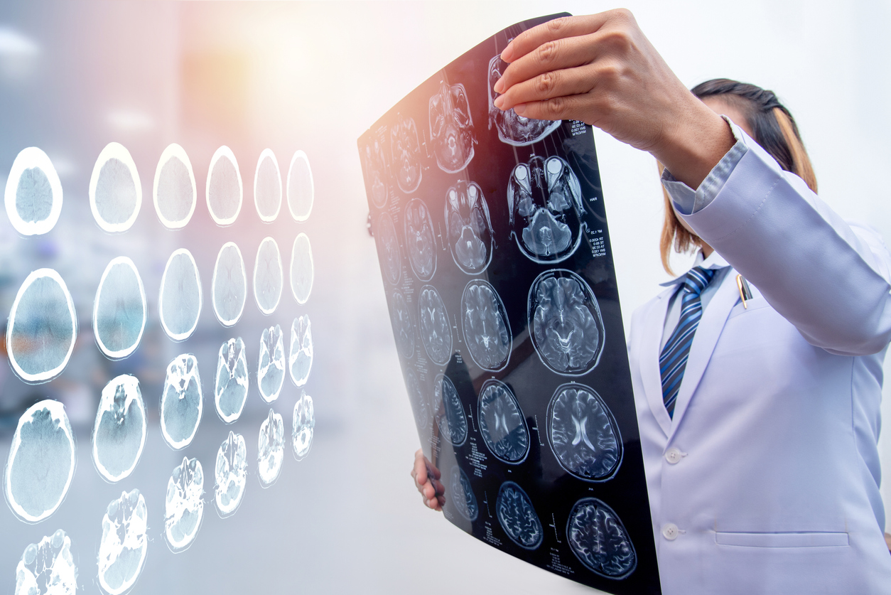 Everything You Need to Know About Brain Stem Injuries
