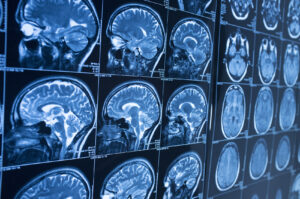 Can a Head Injury Cause a Stroke?