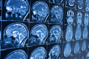 What Are the Types of Traumatic Brain Injuries?